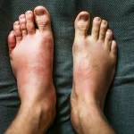 Reasons You Might Have Leg Swelling